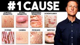 The #1 Deficiency in All Skin Diseases (Dermatitis)