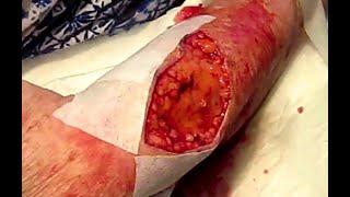 Tumour excision and suturing fragile skin using Hypafix support. #102