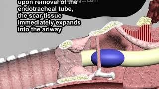 Endotracheal Intubation Complications: Subglottic Stenosis and Laryngeal Edema by Cal Shipley, M.D.