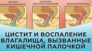 Цистит и воспаление влагалища, вызванные кишечной палочкой