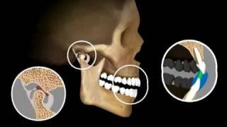 Kois Center - TMJ 2D Simluation