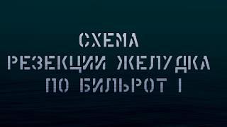 Схема резекции желудка по Бильрот I