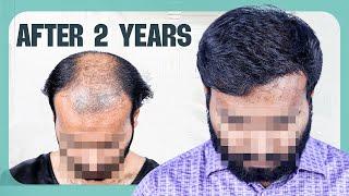 Hair Transformation Success (5000 Grafts)  | Hair Transplant Bangladesh | New Roots