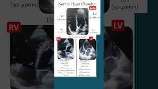 Normal and dilated heart chamber echo l #echo #shorts