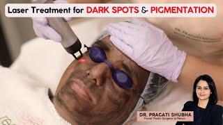 ️ Laser Treatment for Dark Spots & Pigmentation |️Carbon Laser &  Laser Toning Treatment Procedure
