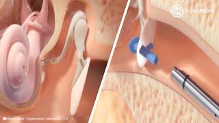 Ear Tube Insertion Procedure (Tympanostomy): Hummingbird in-office Tympanostomy System