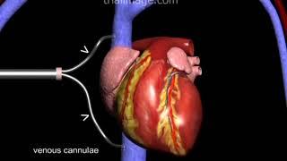 Cardiopulmonary Bypass (in 2 minutes) Animation by Cal Shipley, M.D.