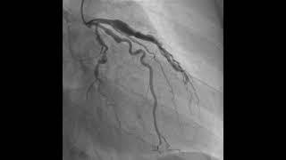 Figure 2: After management - complete resolution of obstruction and restored blood flow