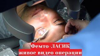 Фемто-ЛАСИК  лазерная коррекция зрения  живое видео из операционной 