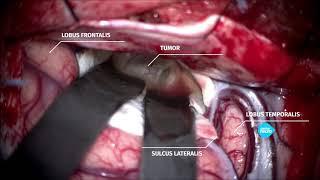 Удаление опухоли головного мозга (краниофарингиомы) у ребенка. Нейрохирург Землянский М.Ю.