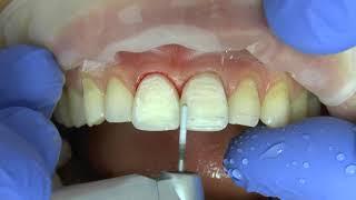 Finishing protocol in direct restoration. Финишная обработка композитной реставрации.