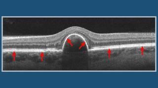 Pigment Epithelium Detachment (PED)