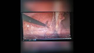 LAPAROSCOPIC RIGHT COLECTOMY WITH EXTRACORPOREAL ANASTOMOSIS D.Haitham Sawalmeh