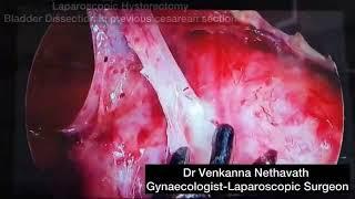 Bladder Dissection during laparoscopic hysterectomy in a case of previous caesarean section