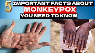 Monkeypox | 5 Important  Facts About Monkeypox You Need To Know