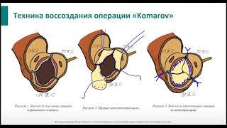 Возможно ли сохранить  нативную анатомию клапана корня аорты при его замене? Ответ ученых в видео!