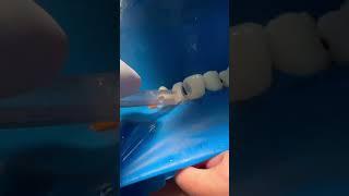 Tooth nerve  #dentist