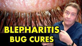 What is Blepharitis and How to Cure it .... For Good.