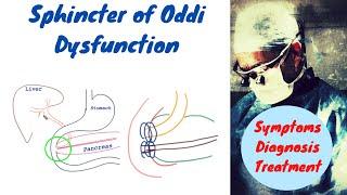 Sphincter of Oddi Dysfunction; Made Easy to understand