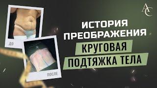 История преображения. Круговая подтяжка тела - бодилифт (торсопластика). До/после