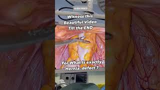 What EXACTLY is HERNIA DEFECT ? Hernia Surgery I Hernia Operation I Inguinal Hernia I India I Surat