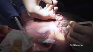 Dr. Stile - Midface Lift Surgery Part 4