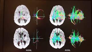 Society for Brain Mapping and Therapeutics (SBMT) - Nasser Kashou Research Overview