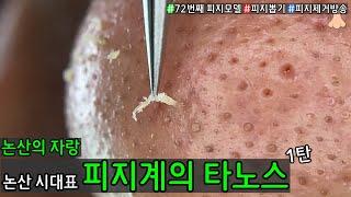 피지 직접 뽑아드렸습니다 _ 피지제거 블랙헤드제거 피지뽑기 _ 논산에 살아있는 피지의 전설 새해를 아주 밝게 빛내주네요 1탄