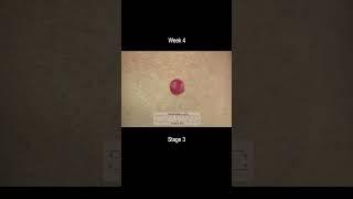 Merkel Cell Carcinoma Development Time Lapse - More Deadly Than Melanoma!