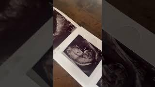 Celebrating life's journey from 5 to 16 weeks  #ultrasound #baby