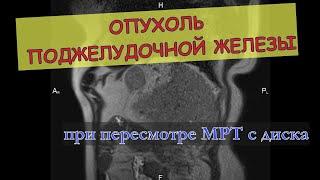 Выявлена ОПУХОЛЬ ПОДЖЕЛУДОЧНОЙ ЖЕЛЕЗЫ на МРТ второе мнение брюшной полости