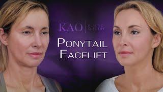 Ponytail Facelift Before & After - 3 Years Later -  It Gets Better With Time?