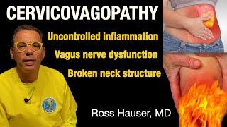 Cervicovagopathy- inflammatory diseases from vagus nerve dysfunction due to neck instability