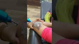 Tattoo removal by picosure laser