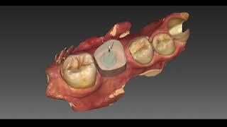 Inlab 18 implant crown