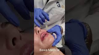 Kysse Lip Filler Treatment at Bawa Medical in Boca Raton