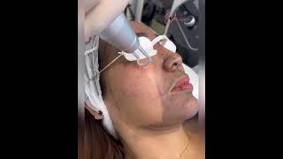 Carbon laser Peel for open pores and acne scars #olimpiacarmen  #hollywoodpeel #laserexperts r