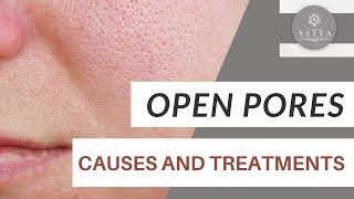 Causes of open pores | How to treat them | Skin Treatment | Satya Skin Clinic Delhi