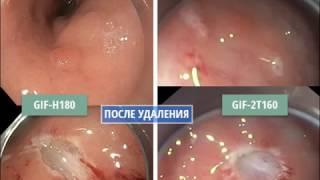 EndoExpert.ru Endoscopic removal of a small gastric carcinoid using double-channel endoscope