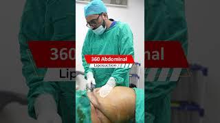 360 degree Abdomen Liposuction Surgery