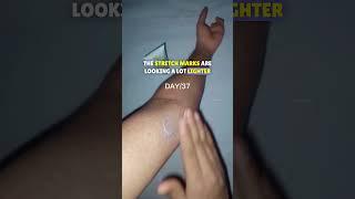 Day 37 Skin Reveal  Fix Derma Cream Results!