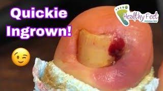 HOW TO TREAT AN INGROWN TOENAIL! | DR. TODD TAMPA PODIATRIST