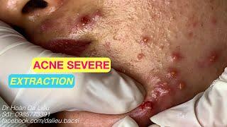 Nặn mụn nhọt ẩn vùng mặt siêu nhiều thâm|Squeeze big pimples, hidden acnes full Dr Hoan 0985773391