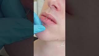 VERTICAL LABRET (Lip) PIERCING