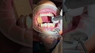 Fixing a crowded smile! #cosmeticdentistry #dentist #veneers #fyp #trending #smilemakeover