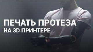 3D печать протезов — 3Dreams в Украине