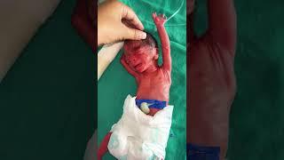 Premature/preterm newborn baby weight 750 grams baby is live