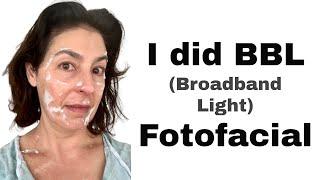 My Experience with BBL (Broadband Light) Fotofacial for Hyperpigmentation | Over 40 | Mature Skin