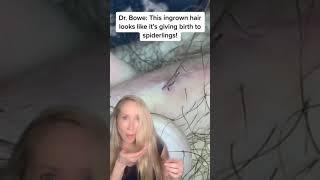 Dermatologist on massive ingrown hair #Shorts