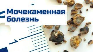 Мочекаменная болезнь | Причины, симптомы, диагностика и лечение